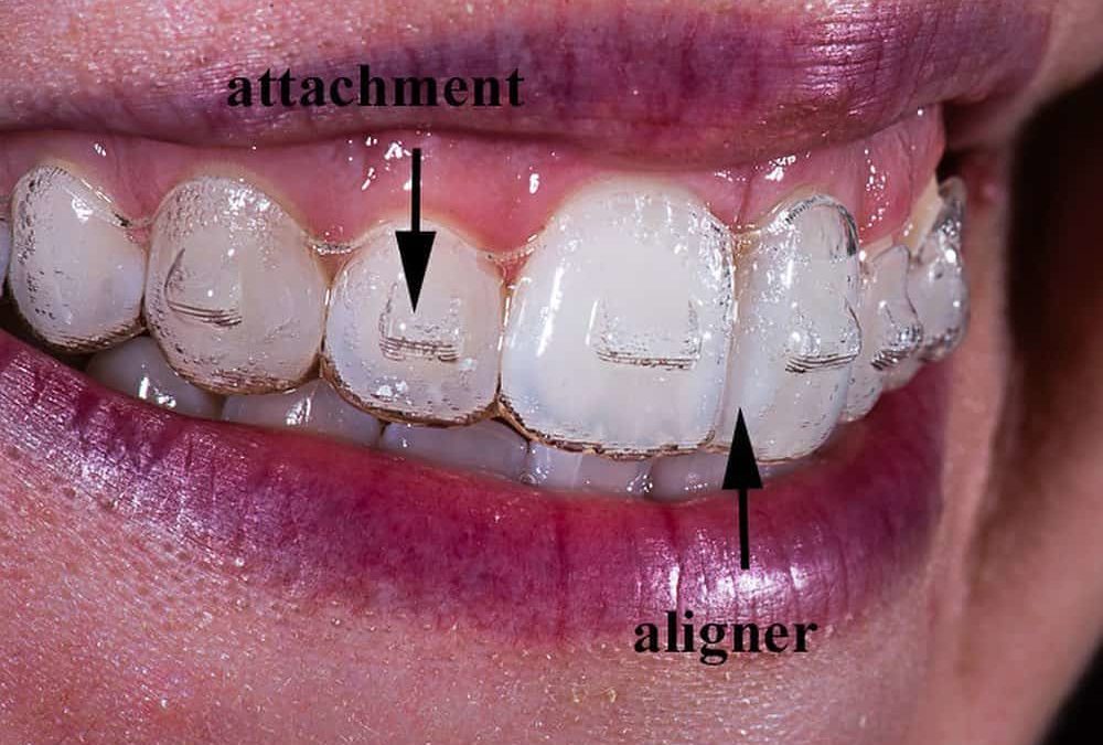 Invisalign Comparison Chart